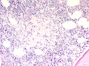 Bone marrow granulomas secondary to Histoplasmosis sepsis - 4.
