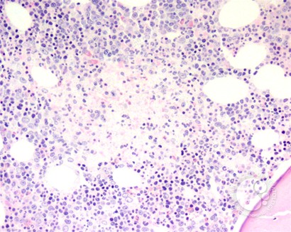 Bone marrow granulomas secondary to Histoplasmosis sepsis - 4.