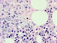 Bone marrow granulomas secondary to Histoplasmosis sepsis - 5.