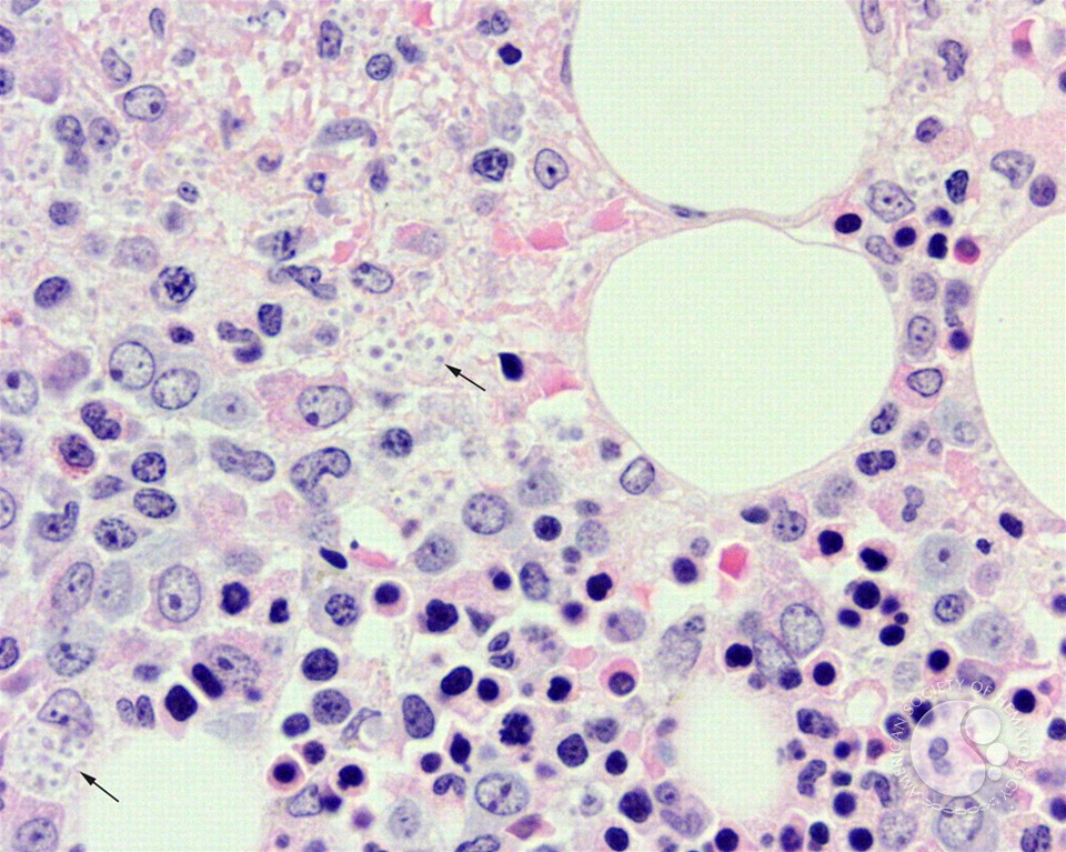 Bone marrow granulomas secondary to Histoplasmosis sepsis - 5.