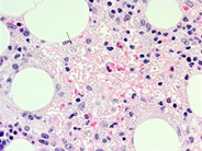 Bone marrow granulomas secondary to Histoplasmosis sepsis - 6.