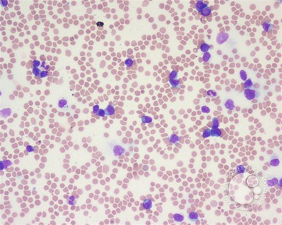 T-cell prolymphocytic leukemia - 1.