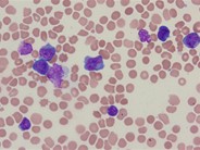 T-cell prolymphocytic leukemia - 2.