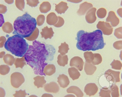 T-cell prolymphocytic leukemia - 3.