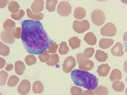 T-cell prolymphocytic leukemia - 4.