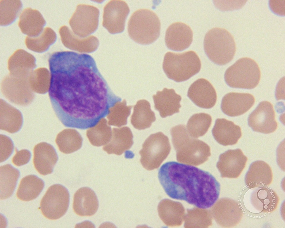 T-cell prolymphocytic leukemia - 4.