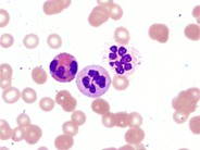 hypersegmented-neutrophil-2