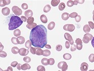 Leukemic phase of large cell lymphoma - 2.