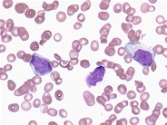 Leukemic phase of large cell lymphoma - 3.