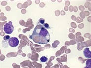 Erythrophagocytosis - 1.