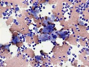 Amyloid – bone marrow aspirate - 2.