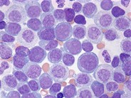 Leukemia cutis - 3