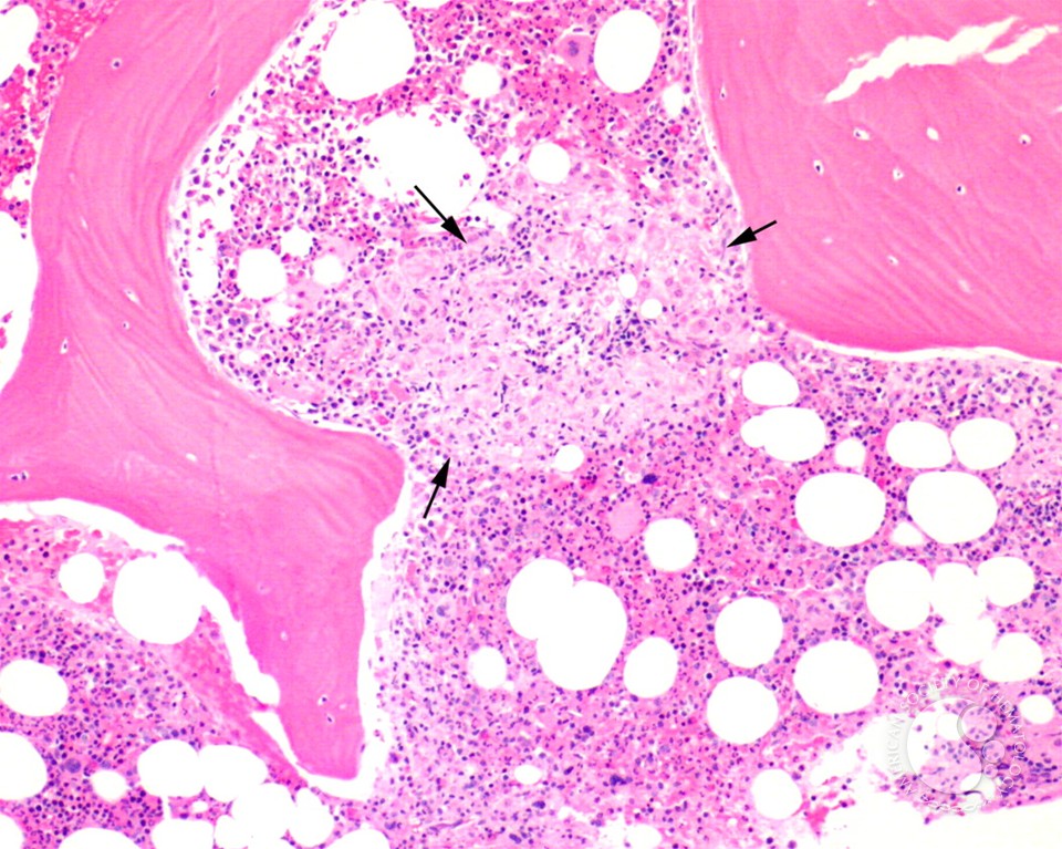 Bone marrow granuloma - 1.