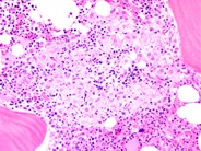 Bone marrow granuloma - 2.