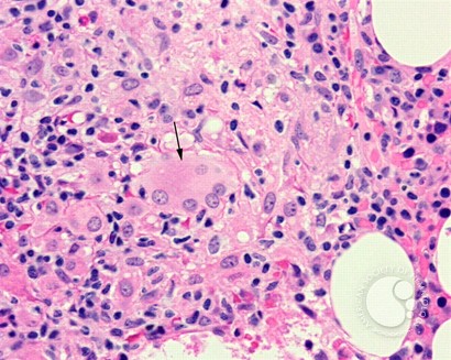 Bone marrow granuloma - 4.