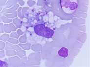 Leishman donovani bodies in peripheral blood smear - 1.