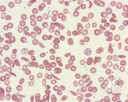 Sickle cell disease – RBC morphology - 1.