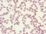 Sickle cell disease – RBC morphology - 3.