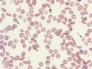 sickle cell morphology rbc disease hematology