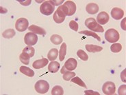 Sickle cell disease – RBC morphology - 4.