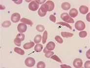 sickle-cell-disease-rbc-morphology-4