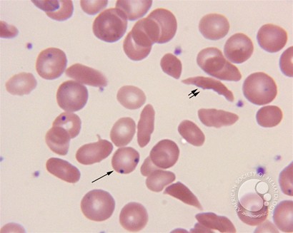 Sickle cell disease – RBC morphology - 4.