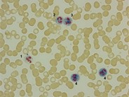 Leukocyte alkaline phosphatase (LAP)scoring - 1.