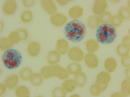 Leukocyte alkaline phosphatase (LAP)scoring - 3.