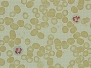 Leukocyte alkaline phosphatase (LAP)scoring - 4.