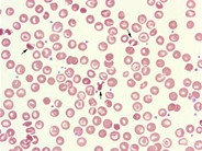 Hemoglobin SC Crystals - 1.