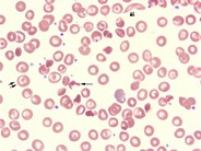 Hemoglobin SC Crystals - 2.