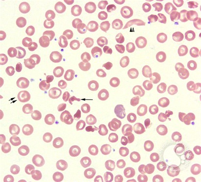 Hemoglobin SC Crystals - 2.