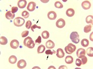 Hemoglobin SC Crystals - 4.