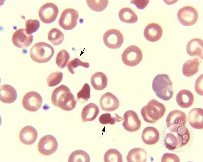Hemoglobin SC Crystals - 4.