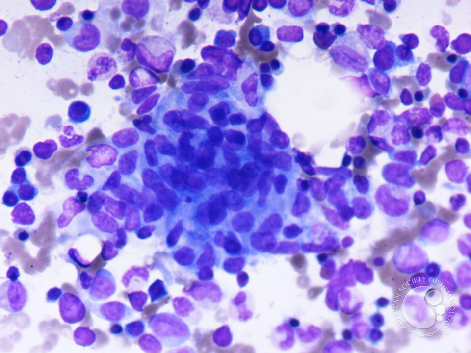 Nonspecific granuloma in bone marrow aspirate - 1.