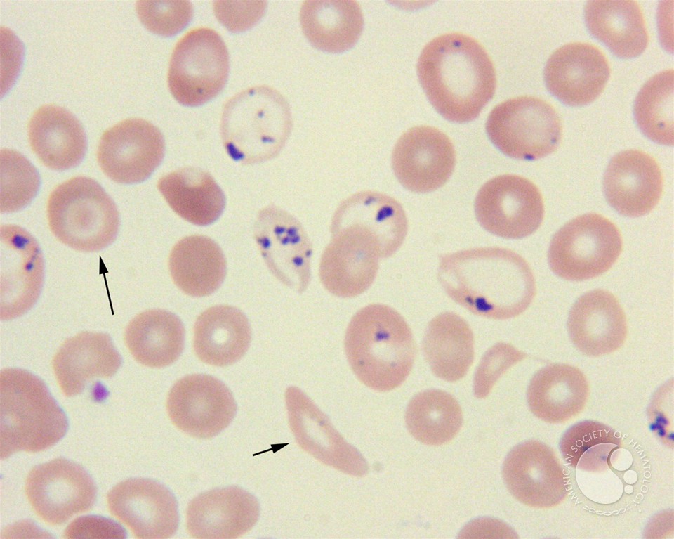 Pappenheimer bodies and basophilic stippling in sickle cell disease - 3.
