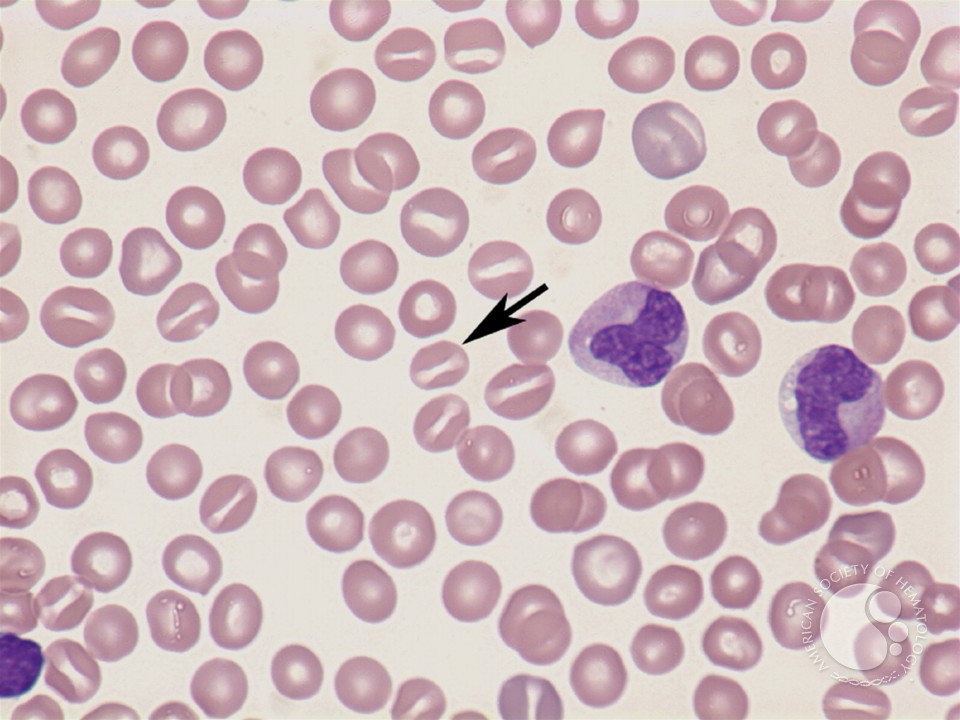 Stomatocyte - 1.