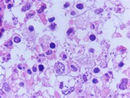 Leishman donovani (LD) bodies in bone marrow biopsy of an adult male with HIV infection - 1.