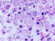 Leishman donovani (LD) bodies in bone marrow biopsy of an adult male with HIV infection - 2.