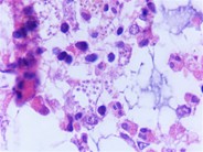 Leishman donovani (LD) bodies in bone marrow biopsy of an adult male with HIV infection - 3.