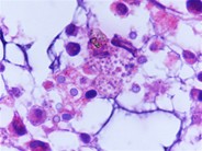 Leishman donovani (LD) bodies in bone marrow biopsy of an adult male with HIV infection - 5.