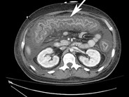 C. difficile colitis - 1.