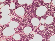 Relapsed precursor B-ALL–bone marrow biopsy - 2.