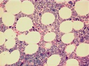 Relapsed precursor B-ALL–bone marrow biopsy - 3.