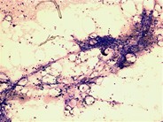 GVHD–bone marrow aspirate - 1.