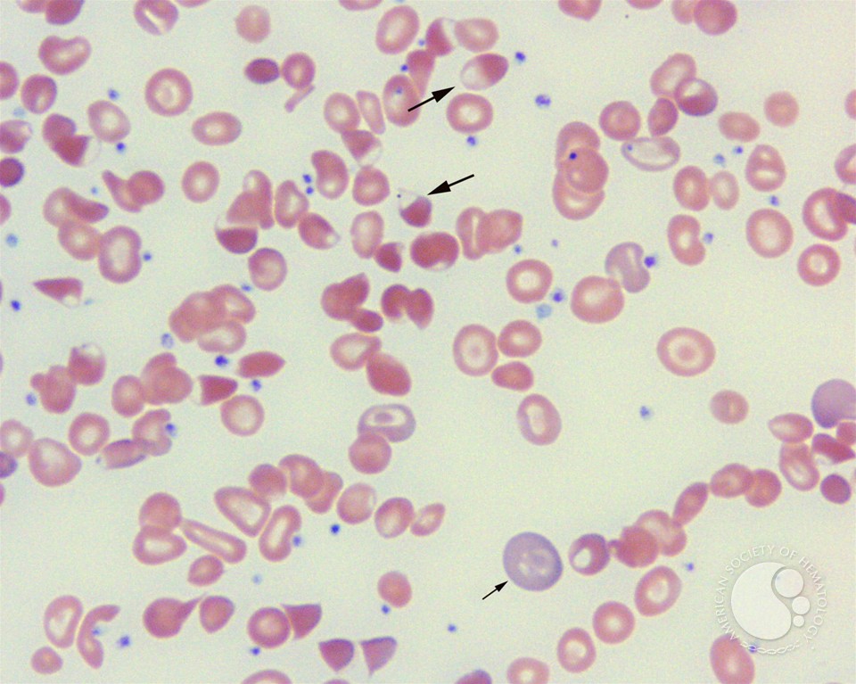 Blister cell - 1.