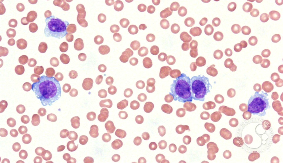 Hemophagocytic lymphohistiocytosis associated with AML-M5a - 1.