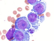 Erythrocyte hemophagocytosis by AML-M5a blasts - 1.