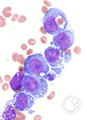 Erythrocyte hemophagocytosis by AML-M5a blasts - 1.