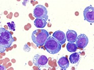 Erythrocyte hemophagocytosis by AML-M5a blasts - 2.